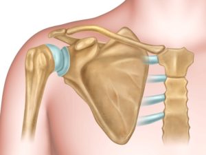 Ausgerenkte Schulter - Ursachen für das Auskugeln