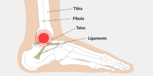 Bänderriss - Verletzung der Knöchelbänder