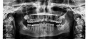 Schlechte Zähne können Performance beeinträchtigen